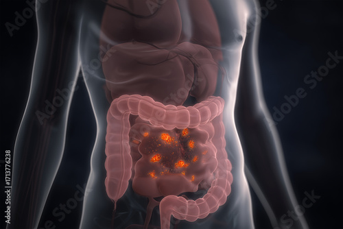3D illustration of intestinal inflammation caused by bacteria like E. coli, Shigella or C. difficile. Human torso showing infected intestines, linked to gastroenteritis and colitis