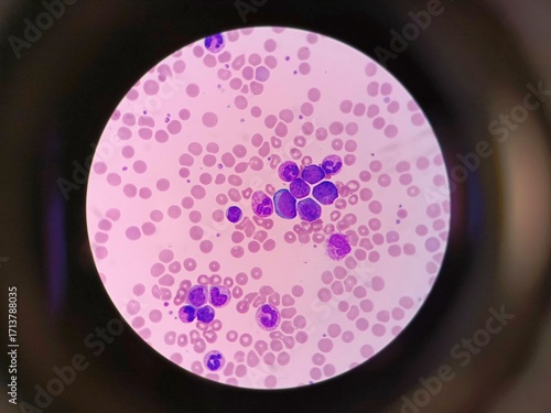 Blood Pathology Under Microscope – Medical Analysis 