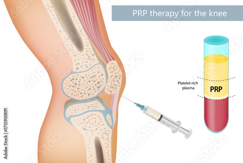 Platelet Rich Plasma Treatment for Knee Osteoarthritis. Medical Illustration of PRP Therapy for Knee Joint. PRP Injection Therapy for Knee