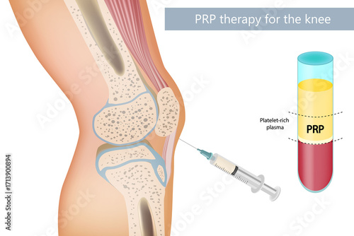 Platelet Rich Plasma Treatment for Knee Osteoarthritis. Medical Illustration of PRP Therapy for Knee Joint. PRP Injection Therapy for Knee