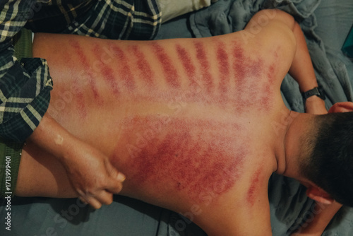 Kerokan or kerikan is a scraping Javanese traditional method of medicine to cure colds.