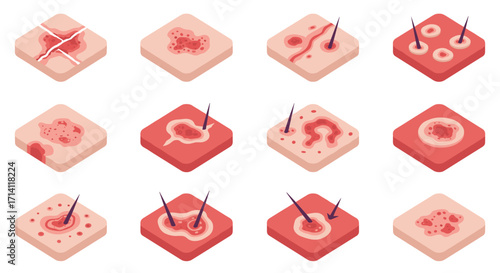 Isometric skin conditions set: acne, pimples, and follicles