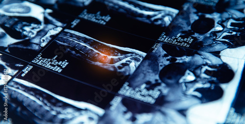 Fotografía Mri scan of spine with disc protrusion highlighted in medical imaging, pinched s