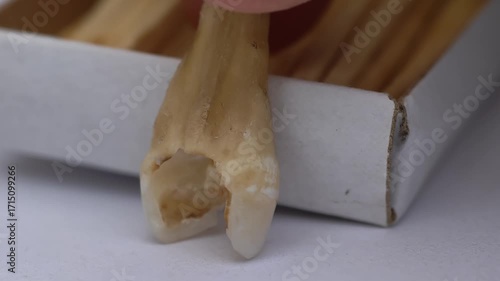 second premolar is torn out, a molar tooth on a white background. Cracked and decayed molar tooth