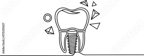 Dental Implant with Geometric Accents and Ring