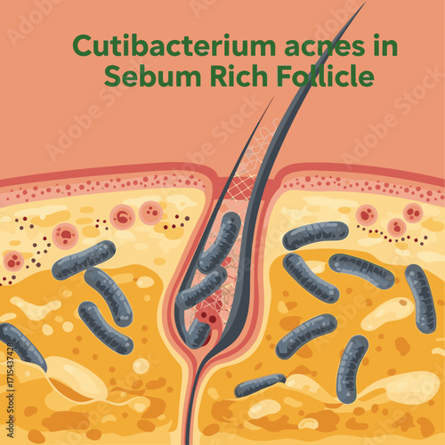 Illustration of Cutibacterium acnes bacteria in sebum-rich follicle causing acne skin condition