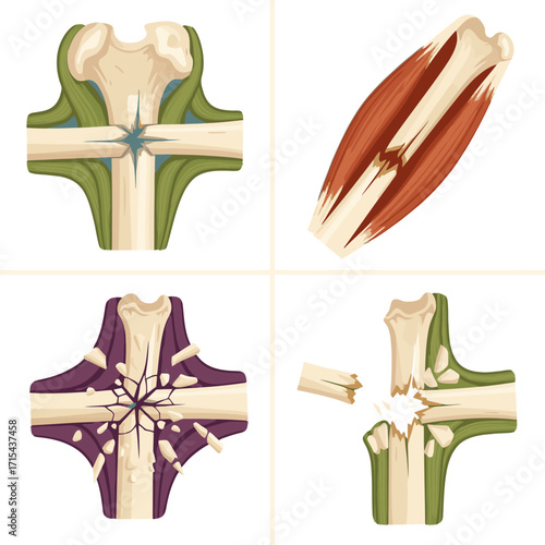 Medical illustration of bone fractures and muscle tears, ideal for healthcare and educational uses