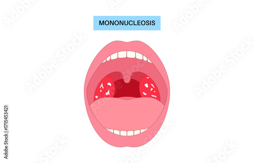 Mononucleosis symptoms poster