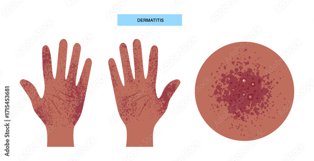 Fototapeta premium Dermatitis medical poster