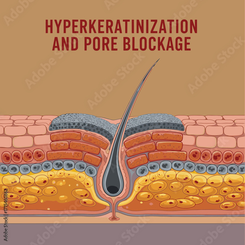 Detailed cross-section of skin layers showing hyperkeratinization and pore blockage with hair follicle