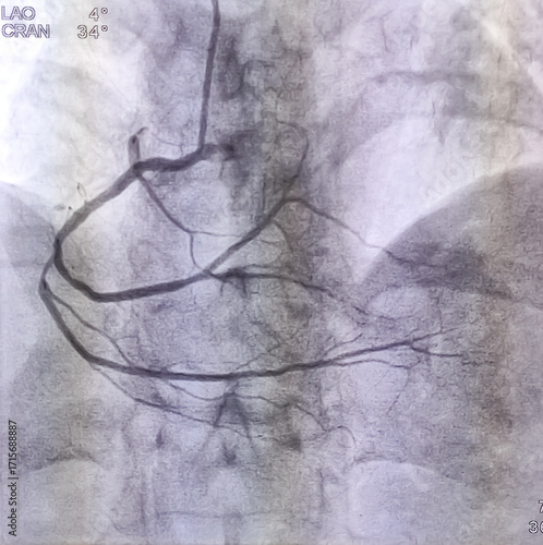 Coronary angiogram of right coronary artery during cardiac catheterization with contrast dye. Abnormal findings. colour adjust.
