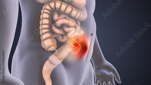 3D Animation Showing Formation of Abdominal Hernia