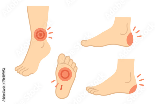 Foot pain vector illustration set. Leg and ankle pain points diagram. Medical anatomy chart for sore heel, sole, plantar fasciitis, sprain, injury, and arthritis inflammation.