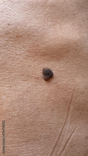 Close-up of Pigmented Skin Mole or Wart on Human Body