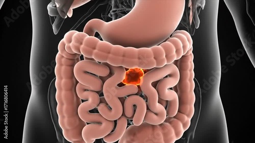 Wallpaper Mural 3D Medical Illustration of Colon Cancer in the Large Intestine.  Torontodigital.ca