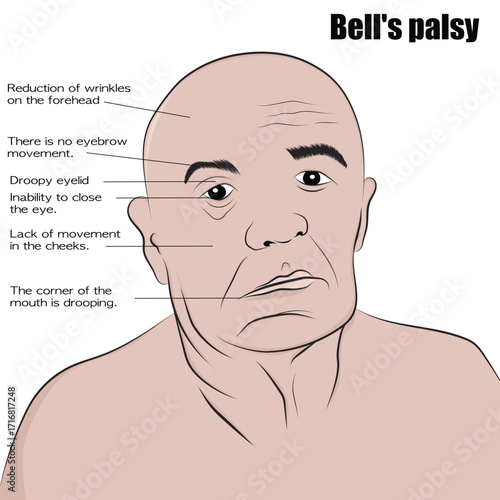 Bell's Palsy, a neurological disorder.