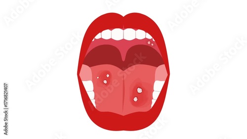Mouth ulcer illustration animation 