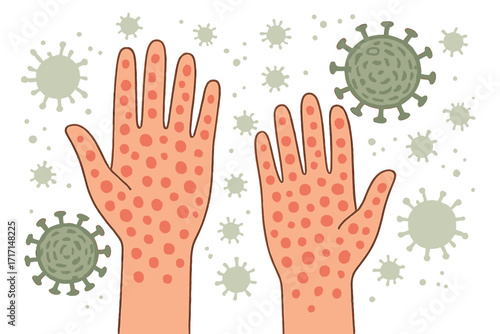 Human hands with monkeypox virus symptoms. Vector illustration of Mpox disease with skin infection. Allergic rash, pimples, and blisters on the body. Microbiology, dermatology concept.