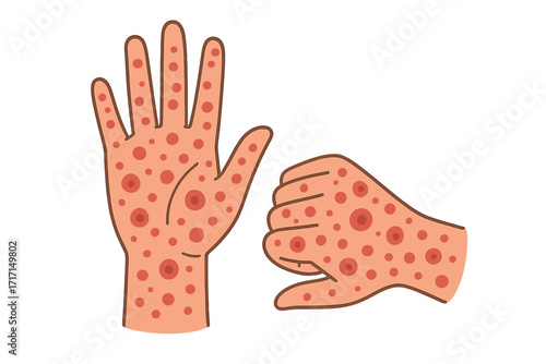 Two hands with monkeypox virus red rashes and spots outbreak, contagious disease skin infection, viral epidemic prevention concept, flat vector cartoon illustration