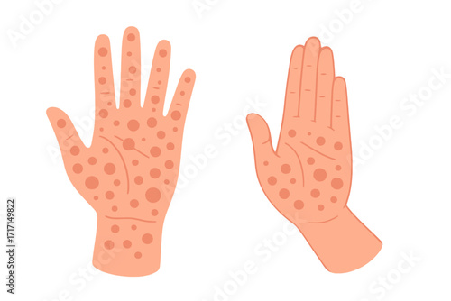 Two hands showing monkeypox virus rashes and spots, infection symptoms on palms, disease outbreak awareness, health protection, vector cartoon illustration with transparent background