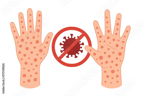 Monkeypox virus rash on two hands, infectious disease skin symptoms, stop new infection concept, isolated flat vector cartoon illustration, rash spots on palms and fingers