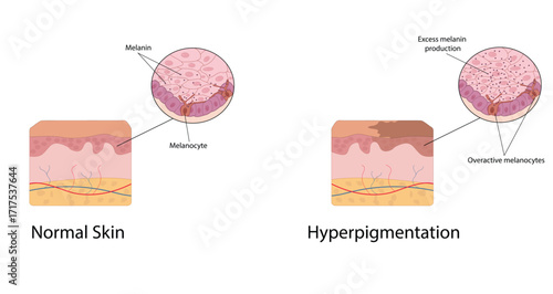 Hyperpigmentation vector illustration