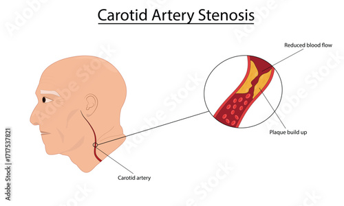 Carotid artery stenosis vector illustration