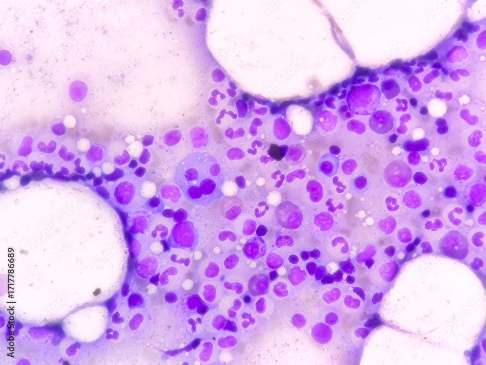 Φωτογραφία Bone marrow study: Plasma cell dyscrasia