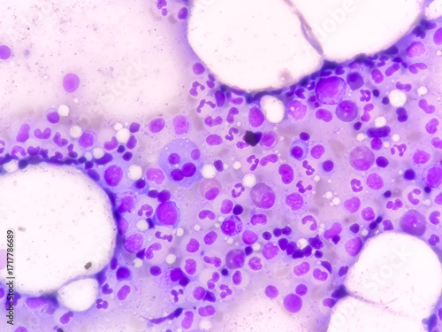 Bone marrow study: Plasma cell dyscrasia. Smoldering or early multiple myeloma (the patient has a history of plasmacytoma at the dorsal vertebral level -L2)