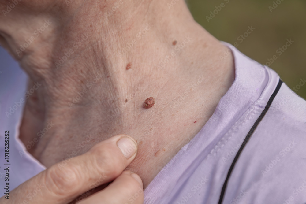 Fototapeta premium Person with a mole on their neck