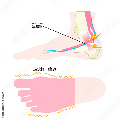 足根管症候群