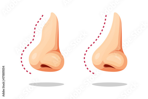 Illustration comparison of nose after plastic surgery .Crooked human nose with signs of plastic surgery.