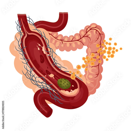 Explore the human colon health with this vibrant illustration showing intestine anatomy and potential health issues for medical education and awareness campaigns