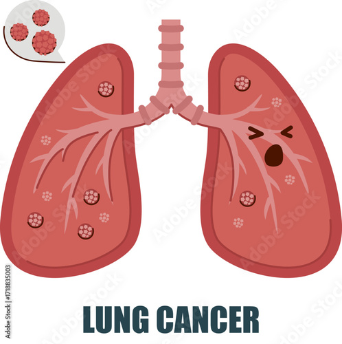 Lung Cancer Awareness Illustration – Symptoms, Causes, Treatment Info