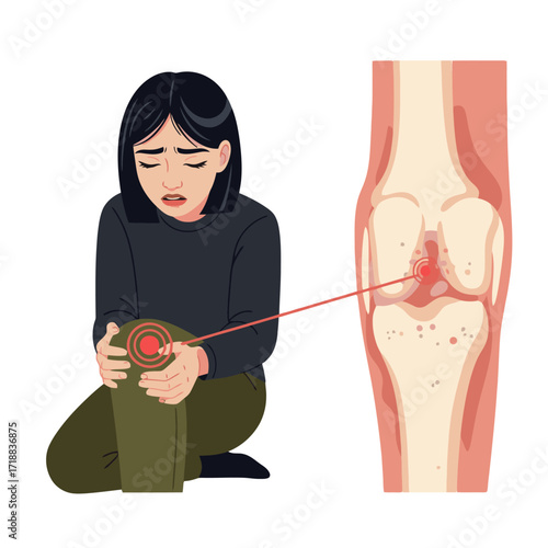 Worried woman holds painful knee with inflammation diagram for medical use, showing joint injury and arthritis pain relief concepts for healthcare marketing
