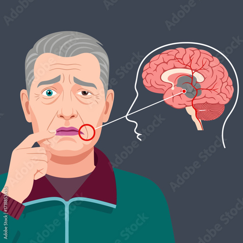 Elderly man showing stroke symptom of facial droop with brain graphic for medical education and healthcare marketing, highlighting neurological health