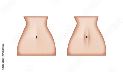 Woman's abdomen showing diastasis recti and normal abdomen comparison