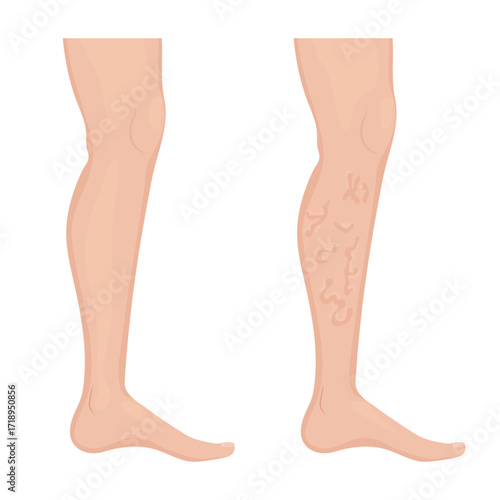 Comparing healthy leg with varicose veins, showing vascular disease development