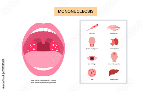 Mononucleosis symptoms poster