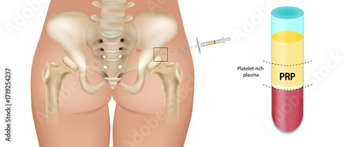 Platelet Rich Plasma Injection in Hip Joint. Plasma Treatment in Orthopedic Joint Care. Regenerative Medicine Concept. Medical Illustration