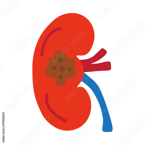 kidney cancer