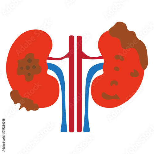 kidney cancer