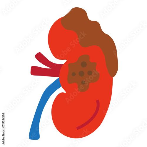 kidney cancer
