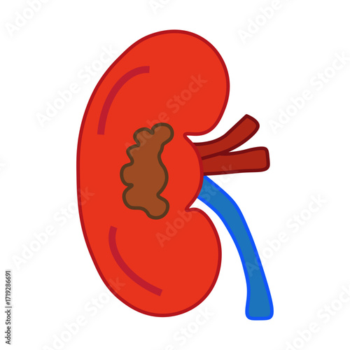 kidney cancer