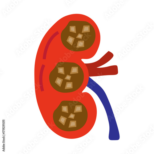 chronic kidney stone disease