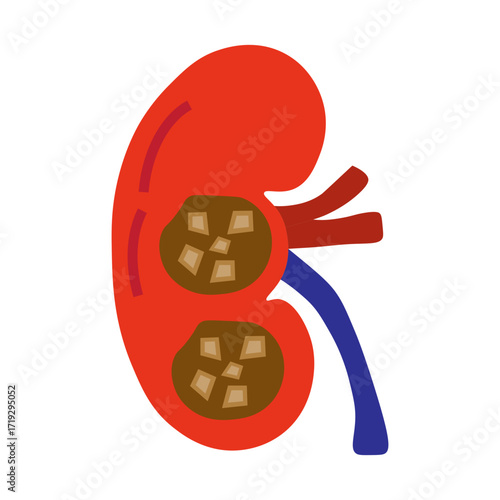 chronic kidney stone disease