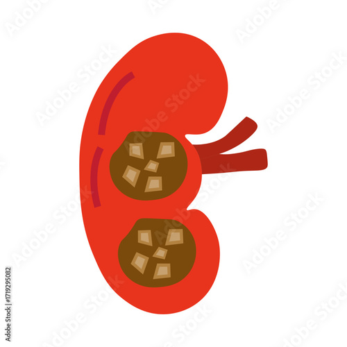 chronic kidney stone disease