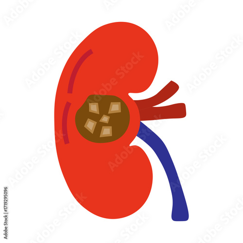 chronic kidney stone disease
