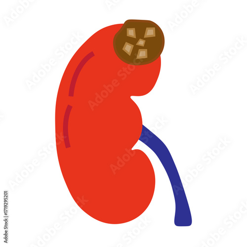 chronic kidney stone disease