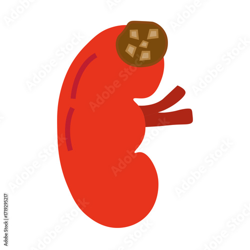 chronic kidney stone disease